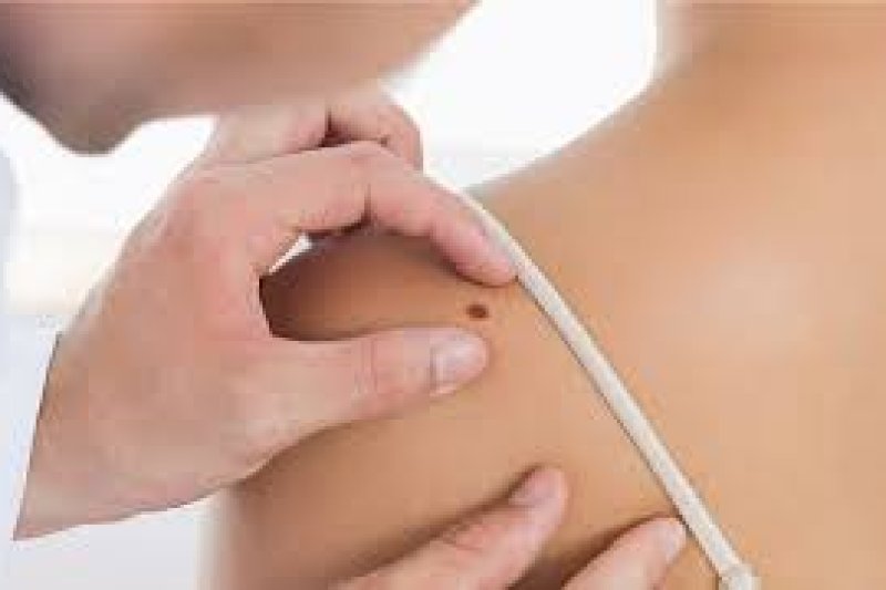 HOSPITAL HLA SAN CARLOS: El melanoma es un cáncer que diagnosticado precozmente no tiene por qué asustar HOSPITAL HLA SAN CARLOS: El melanoma es un cáncer que diagnosticado precozmente no tiene por qué asustar