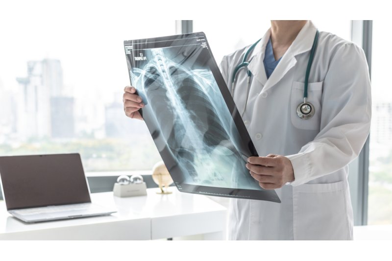 EPOC, una enfermedad crónica que afecta a 480 millones de personas en el mundo EPOC, una enfermedad crónica que afecta a 480 millones de personas en el mundo