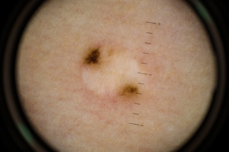 El Hospital HLA San Carlos de Denia adquiere un Dermatoscopio Digital que mejora el diagnóstico de las lesiones cutáneas El Hospital HLA San Carlos de Denia adquiere un Dermatoscopio Digital que mejora el diagnóstico de las lesiones cutáneas